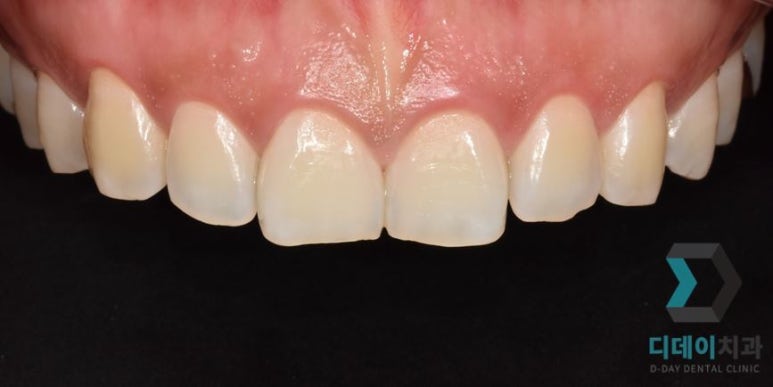 치아성형 종류, 비용, 장단점까지 완벽정리 관련 이미지 14