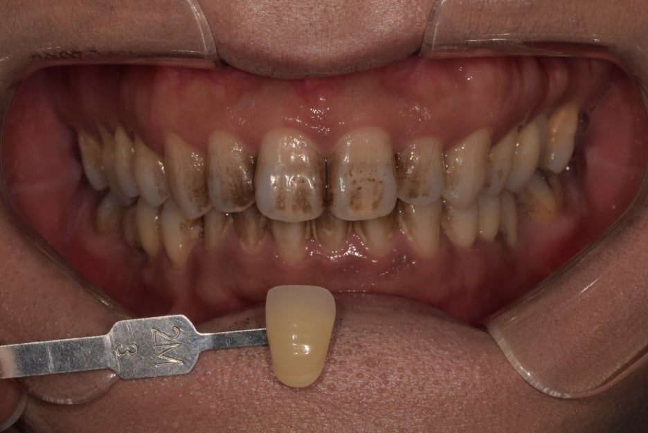 최소증상 치아미백 치과 후기,일본에서도 오는 이유? 관련 이미지 1