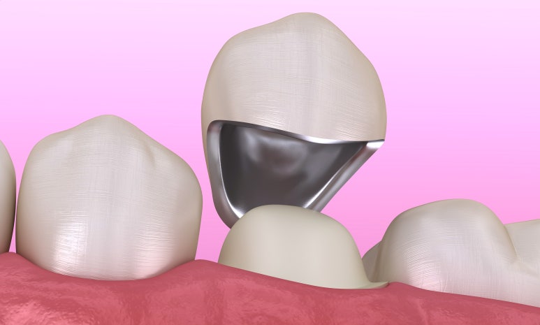 선정릉역치과, 합리적인 비용? 의사가 알려드립니다 관련 이미지 6