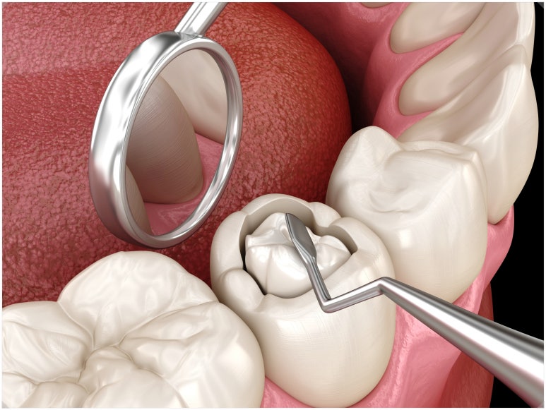 충치치료고통...힘드신 분들께 의사가 드리는 이야기 관련 이미지 1
