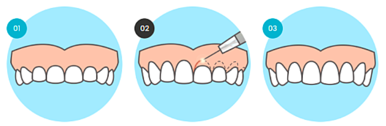 잇몸비대칭, 치아/잇몸성형 A-Z 까지 의사가 알려드립니다. 관련 이미지 1