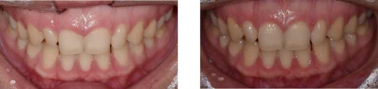 잇몸성형 비용, 통증, 회복기간, 후기까지 총정리 관련 이미지 5