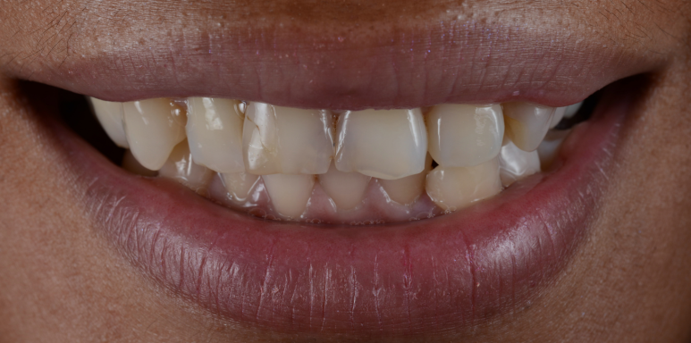 라미네이트재시술?00부터 확인하세요. 관련 이미지 5