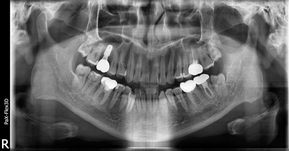 상악동거상술비용, 투명하게 공개합니다 관련 이미지 8