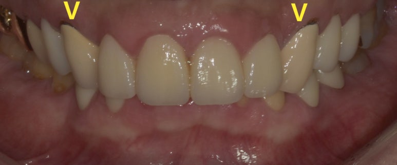 PFM? 지르코니아? 치아색 크라운 전격 해부 관련 이미지 4