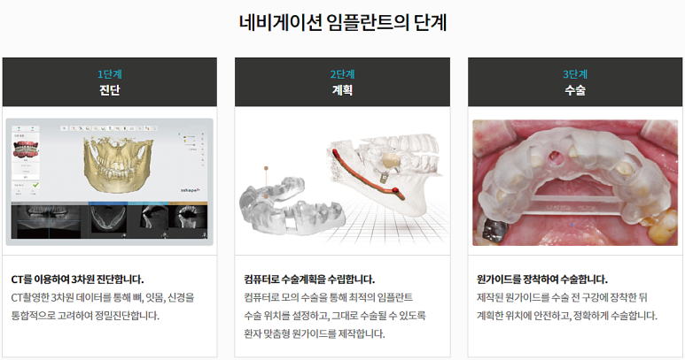 임플란트상악동거상술, 통증은 OO 때문이다? 관련 이미지 12