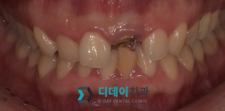 치아쪼개짐, 바로 치과 안가면 신경치료까지 갑니다 관련 이미지 6
