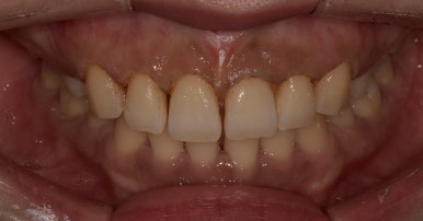 [진심인터뷰] &ldquo;잇몸성형, 안 할 이유가 1도 없어요&rdquo; 예비신부의 후기 관련 이미지 8