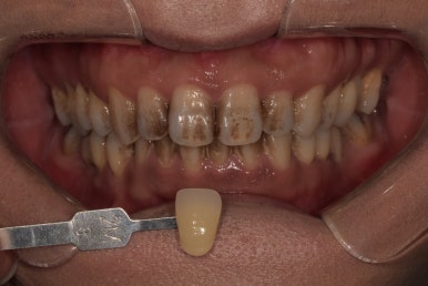 치아미백비용, 치과가 10배 비싼데도 시술하는 이유? 관련 이미지 1