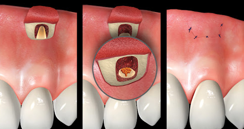 왼쪽어금니통증, 방치하면 안 되는 이유 3가지 관련 이미지 6
