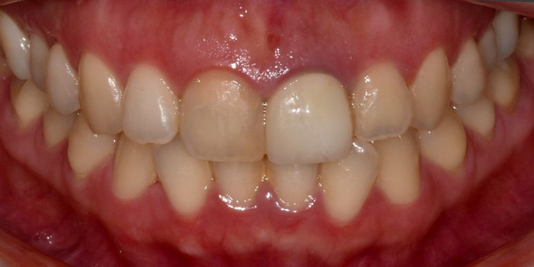 올세라믹vs지르코니아 크라운 비교분석과 비용까지 관련 이미지 9