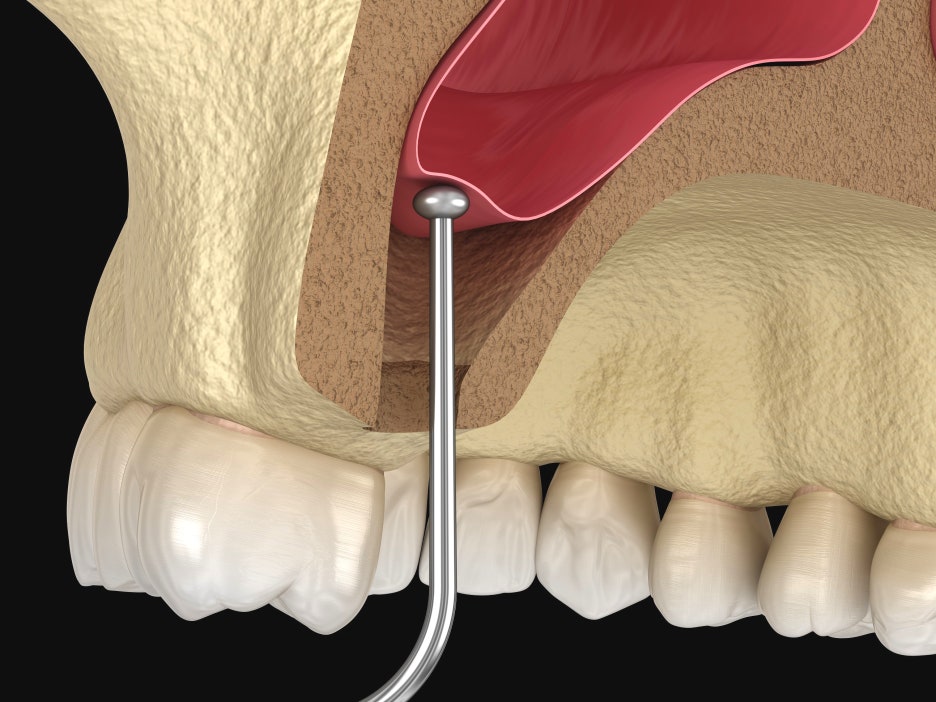 상악동거상술비용, 투명하게 공개합니다 관련 이미지 3