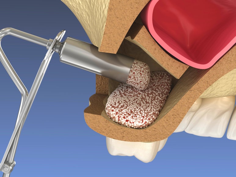 상악동 거상술 비용, 통증까지 치과의사가 알려드립니다 관련 이미지 6