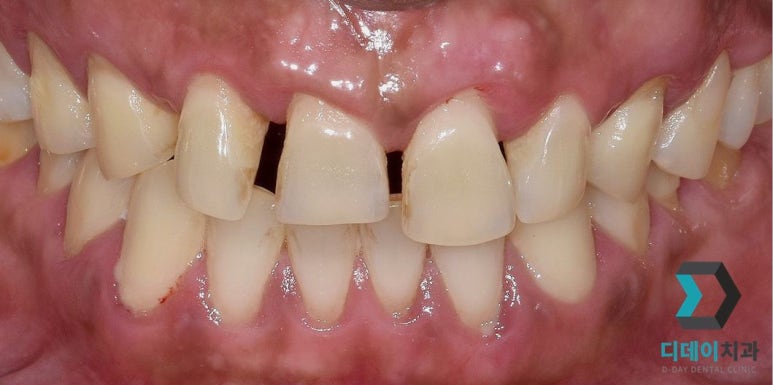 라미네이트후기, 치료사례만 모아 보여드립니다 관련 이미지 5