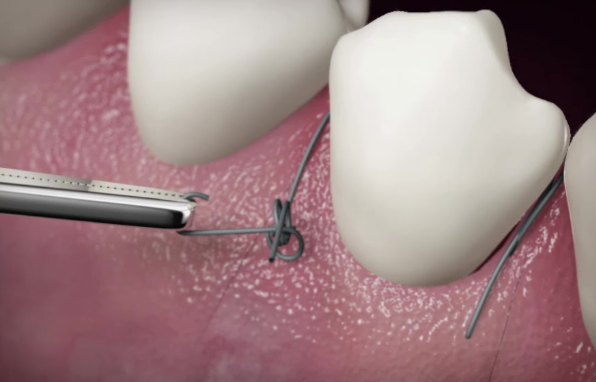 임플란트실밥제거 과정, 이것만 알면 됩니다 관련 이미지 3