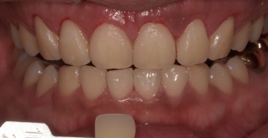 법랑질성형, 잇몸성형, 치아미백까지! 디데이치과 심미치료 총집합 치료사례 관련 이미지 9