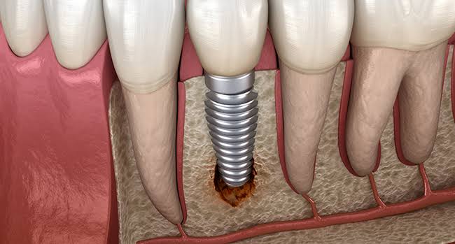 임플란트흔들림? 당황하지 말고 바로 해야할 일은? 관련 이미지 5