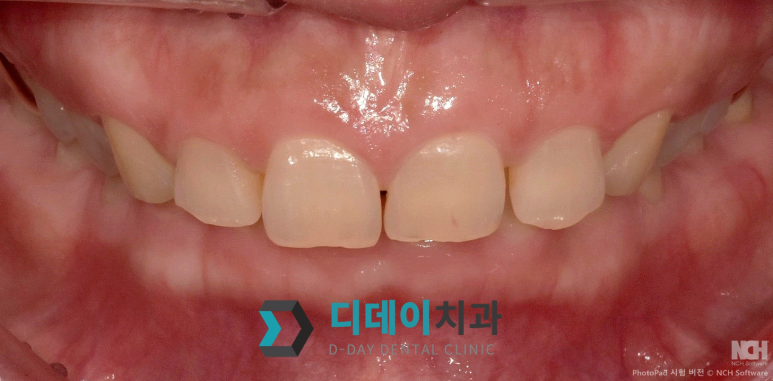 언주역치과 라미네이트 잘하는 곳? 관련 이미지 2