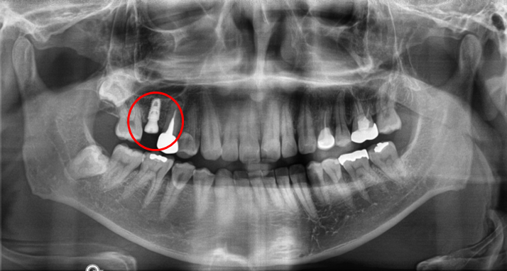 청담역치과? "뼈이식 없이" 임플란트 진행 사례 관련 이미지 3