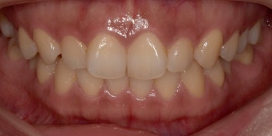 교정? 라미네이트? 앞니배열 바꾸려면 뭐가 더 좋을까? 관련 이미지 6