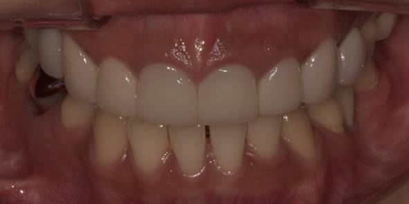 라미네이트통증, 아플까봐 걱정된다면? 확인해보세요 관련 이미지 8