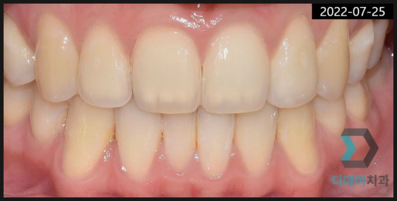 학동역 치과? 치료받고 후회하지 않으려면... 관련 이미지 2