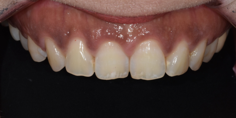 라미네이트 전후 비교, 주의사항, 비용까지 총정리 관련 이미지 13