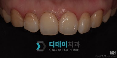 Gangnam Gum Contouring—Doesn’t It Hurt? An Honest Account of the Pain image 10