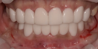 라미네이트 전후사진과 치료비용까지 숨김없이 알려드립니다. 관련 이미지 15