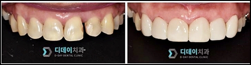 치아사이레진, 재시술을 받지 않으려면 관련 이미지 5