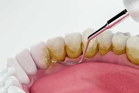 강남역스케일링, 미루면 치료비 10배 더 나옵니다 관련 이미지 2