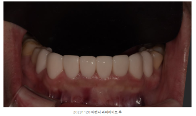 라미네이트유지기간, 절반도 못 쓰고 후회하는 환자들의 공통점 관련 이미지 4