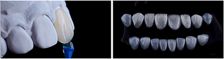 라미네이트 주의사항? 잘못 시술되면 이런 부작용 옵니다... 관련 이미지 8