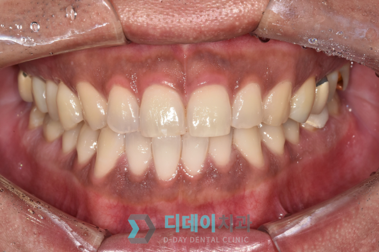 잇몸이 까매요.. 잇몸미백치료 사례 공개합니다 관련 이미지 5