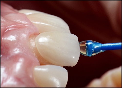 옥니라미네이트, 치과 전문의가 알려드릴께요. 관련 이미지 5