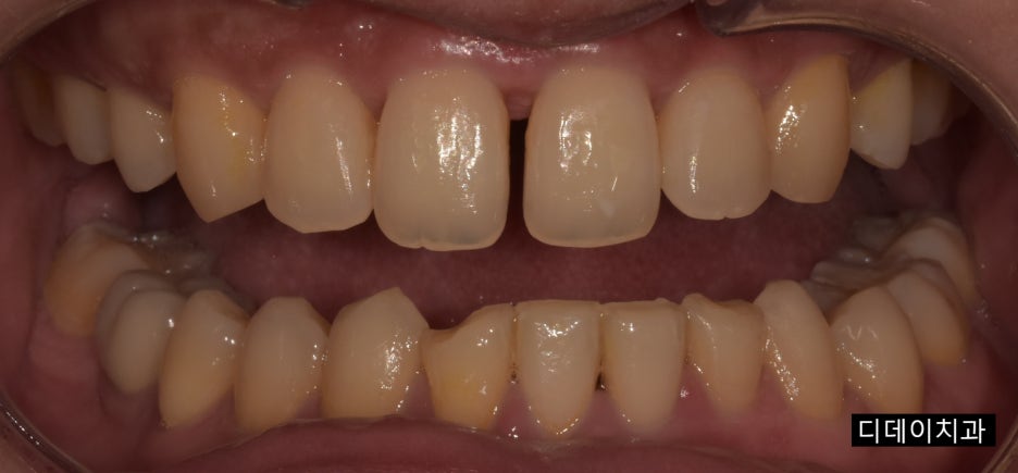 치아레진수명,10년 이상 쓰려면 이것만은 알아야 합니다 관련 이미지 6