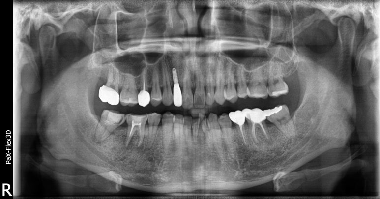 20대임플란트 수명? 평생 못쓸수도 있습니다. 관련 이미지 2