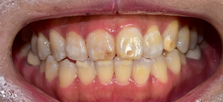 치아반점(반상치, 반점치) 혹시 문제있는건 아닌지 걱정된다면? 관련 이미지 8