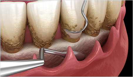 선릉역잇몸치료, 붓고 피나는 잇몸 좋아지기 위해 반드시 해야하는 일? 관련 이미지 7