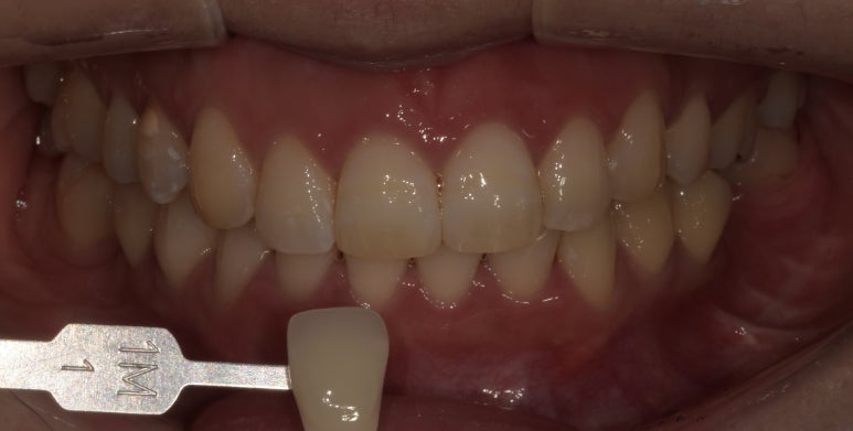 앞니성형? 라미네이트 없이 치아성형하는 방법 관련 이미지 7