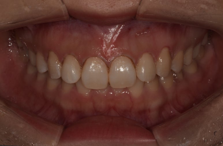 잇몸성형 비용과 자주묻는 질문 답변까지 이 글로 정리합니다. 관련 이미지 9