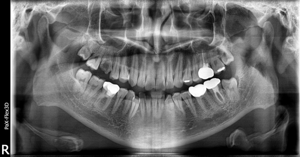 상악동거상술비용, 투명하게 공개합니다 관련 이미지 5
