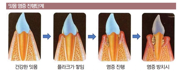 잇몸치료레이저, 받기 전 이것만은 꼭 확인하세요 관련 이미지 4