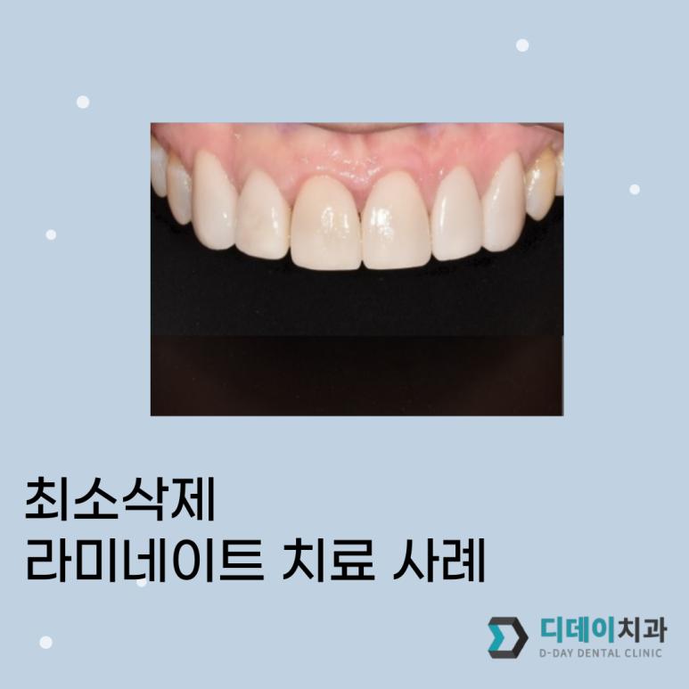 강남/강남역 라미네이트? 시술 전 필독 글 관련 이미지 1