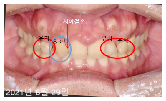 앞이빨임플란트? 3가지 원칙부터 확인하세요. 관련 이미지 4