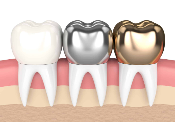 역삼동 크라운 치과 치료 필요한 치아상태, 꼭 확인하세요. 관련 이미지 6