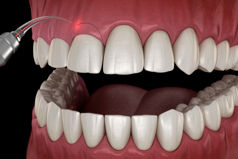 잇몸성형가격? 비용, 주의사항, 치료 후기 공개 관련 이미지 4