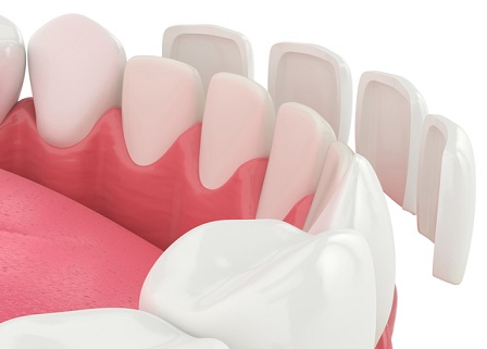 대치역치과, 라미네이트 잘하는 곳 찾으세요? 2가지면 됩니다 관련 이미지 3