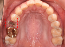 임플란트평생 사용 가능할까? 현직자가 공개합니다. 관련 이미지 5