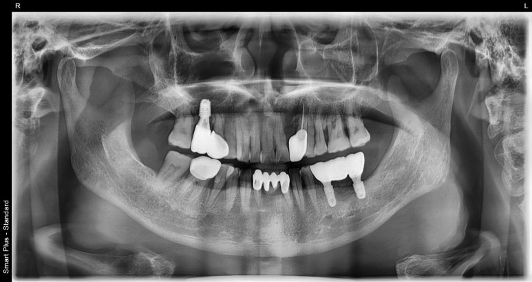 임플란트브릿지? 치아 개수대로 임플란트 심지 않아도 됩니다 관련 이미지 5